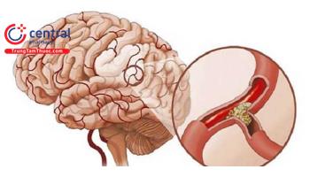 Tai biến mạch máu não (Đột quỵ): Chẩn đoán và phác đồ xử trí