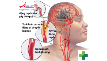 Những điều cần biết về tai biến mạch máu não (đột quỵ não)