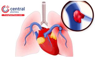 Tăng áp động mạch phổi: Nguyên nhân và cách điều trị