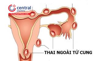 Thai lạc chỗ sau quá trình thụ tinh trong ống nghiệm