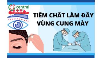 Tiêm chất làm đầy vùng cung mày trong phẫu thuật thẩm mỹ