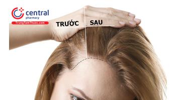 8 dầu gội trị rụng tóc, kích thích mọc tóc được ưa chuộng hàng đầu