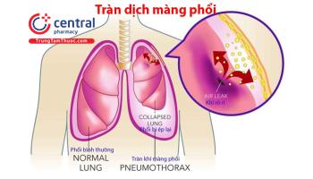 Tràn dịch màng phổi: Chẩn đoán và điều trị 