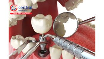 FDA cảnh báo: Trồng răng implant có thể gây tổn thương dây thần kinh
