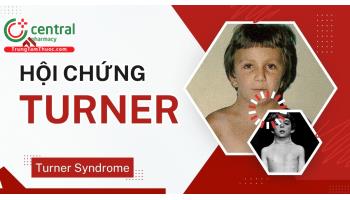 Hội chứng Turner có chữa được không? Nguyên nhân, triệu chứng thường gặp