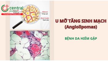 U mỡ tăng sinh mạch (Angiolipomas): Biểu hiện, cách chẩn đoán và điều trị