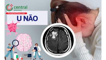 Bệnh u não có chữa được không? 7 dấu hiệu nhận biết u não giai đoạn đầu