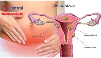 U xơ tử cung: nguyên nhân, triệu chứng và cách điều trị