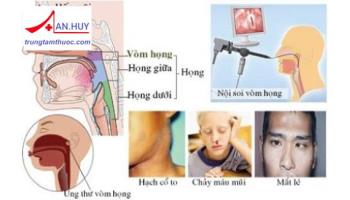 Ung thư vòm họng: Nguyên nhân, triệu chứng, điều trị