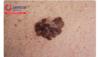 Ung thư da tế bào hắc tố (Melanoma): Triệu chứng và điều trị