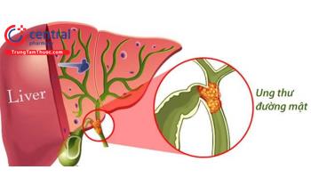 Ung thư đường mật: Nguyên nhân, triệu chứng, điều trị