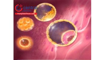 Ung thư nguyên bào nuôi: nguyên nhân, triệu chứng và cách điều trị