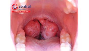 Ung thư vòm mũi họng: yếu tố nguy cơ, triệu chứng và điều trị