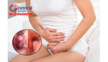 Viêm âm đạo: triệu chứng, nguyên nhân và cách phòng ngừa
