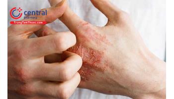 Viêm da tiếp xúc dị ứng: nguyên nhân chẩn đoán và điều trị
