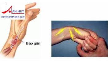 VIÊM ĐIỂM BÁM GÂN VÀ MÔ MỀM QUANH KHỚP: CHẨN ĐOÁN VÀ ĐIỀU TRỊ