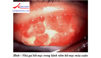 Bệnh viêm kết mạc mùa xuân: nguyên nhân và cách điều trị