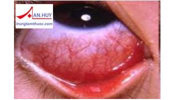Bệnh viêm kết mạc dị ứng cấp tính và cách điều trị