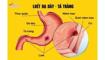 CÁC THUỐC ĐIỀU TRỊ BỆNH LOÉT DẠ DÀY - TÁ TRÀNG