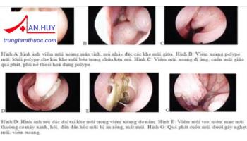 VIÊM MŨI CẤP: TRIỆU CHỨNG, NGUYÊN NHÂN VÀ ĐIỀU TRỊ