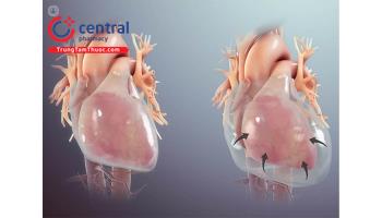Viêm màng ngoài tim: Chẩn đoán và hướng dẫn điều trị
