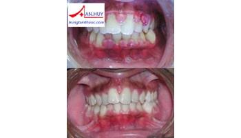 Bệnh viêm nướu triển dưỡng: chẩn đoán và điều trị