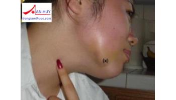 Bệnh viêm nhiễm vùng hàm mặt: chẩn đoán và điều trị