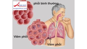 Viêm phổi mắc phải ở cộng đồng: nguyên nhân và cách điều trị