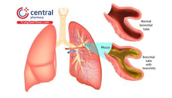 Viêm phế quản cấp: nguyên nhân, triệu chứng và phác đồ điều trị