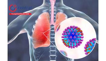 Viêm phổi mắc phải tại cộng đồng: Nguyên nhân, chẩn đoán và điều trị
