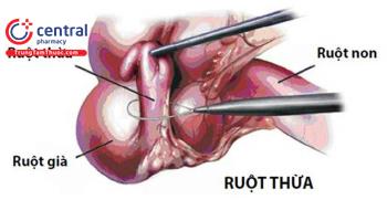 Viêm ruột thừa: nguyên nhân, chẩn đoán và điều trị