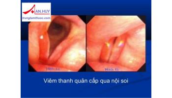 VIÊM THANH QUẢN CẤP Ở TRẺ EM: TRIỆU CHỨNG VÀ ĐIỀU TRỊ