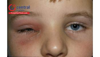 Viêm tổ chức hốc mắt: triệu chứng và điều trị bệnh