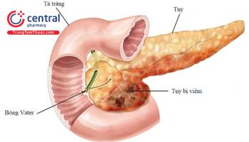 Viêm tụy mạn: nguyên nhân, triệu chứng và cách điều trị