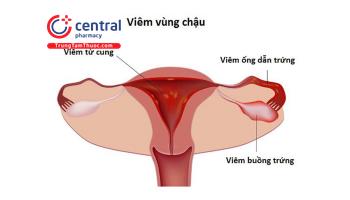 Viêm vùng chậu: nguyên nhân, triệu chứng và cách điều trị