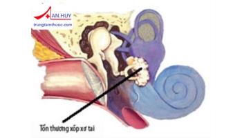 BỆNH XỐP XƠ TAI: TRIỆU CHỨNG, CHẨN ĐOÁN VÀ ĐIỀU TRỊ