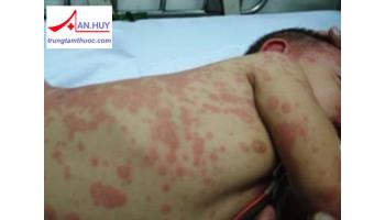 ĐIỀU TRỊ XUẤT HUYẾT GIẢM TIỂU CẦU NGUYÊN PHÁT Ở TRẺ EM