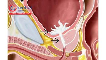 Xuất tinh ngược: Nguyên nhân, triệu chứng và hướng dẫn điều trị