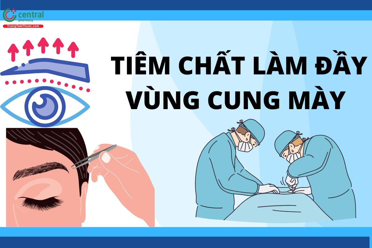 Tiêm chất làm đầy vùng cung mày trong phẫu thuật thẩm mỹ