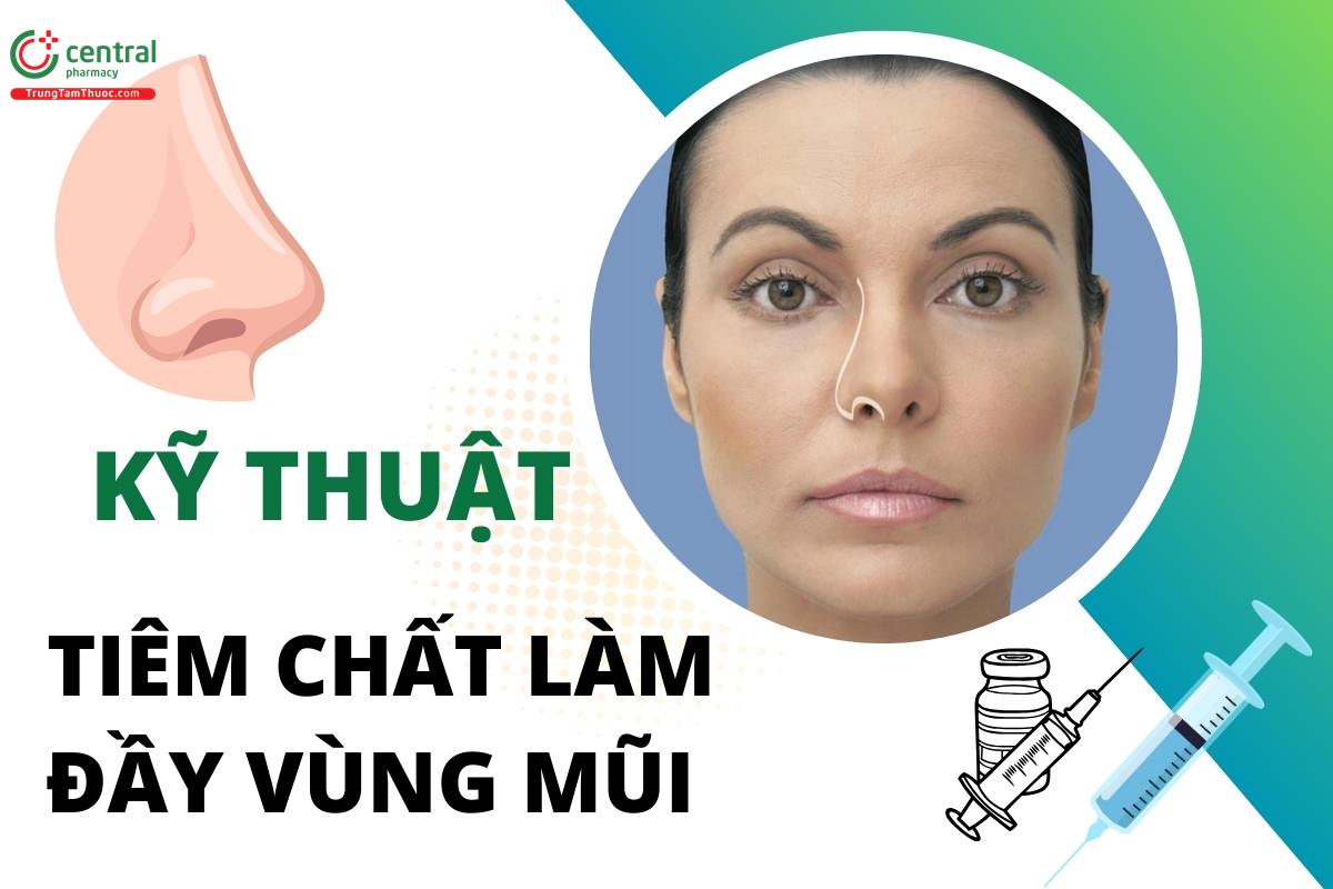 Chi tiết kỹ thuật tiêm chất làm đầy vùng mũi trong phẫu thuật thẩm mỹ