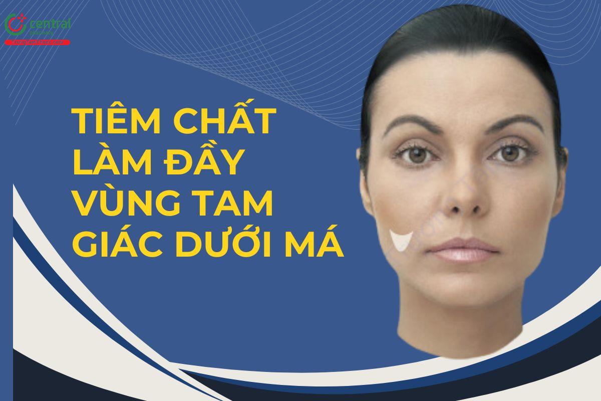 Kỹ thuật tiêm chất làm đầy vùng tam giác dưới má đúng cách