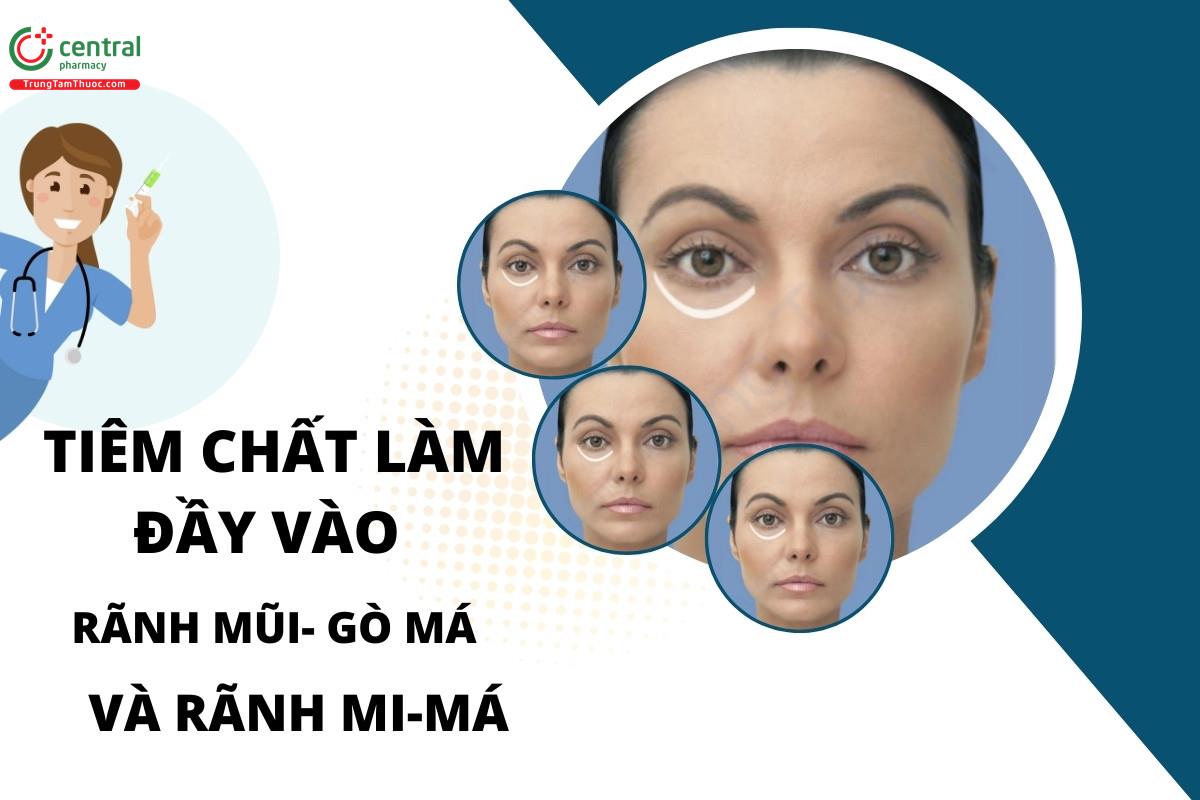 Kỹ thuật tiêm chất làm đầy vào rãnh mũi- gò má và rãnh mi-má