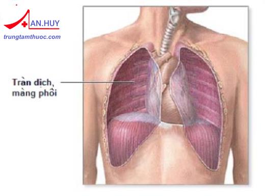 Tràn dịch màng phổi không do lao: nguyên nhân và cách điều trị