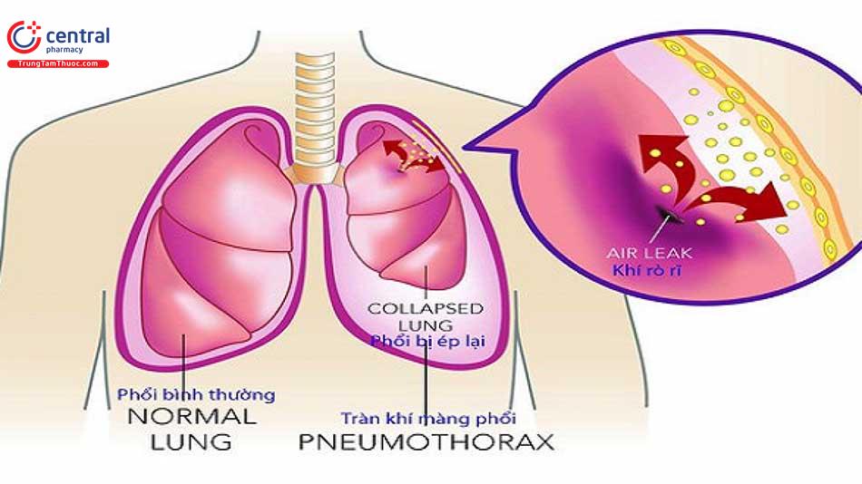 Tràn khí màng phổi: nguyên nhân, chẩn đoán và cách điều trị