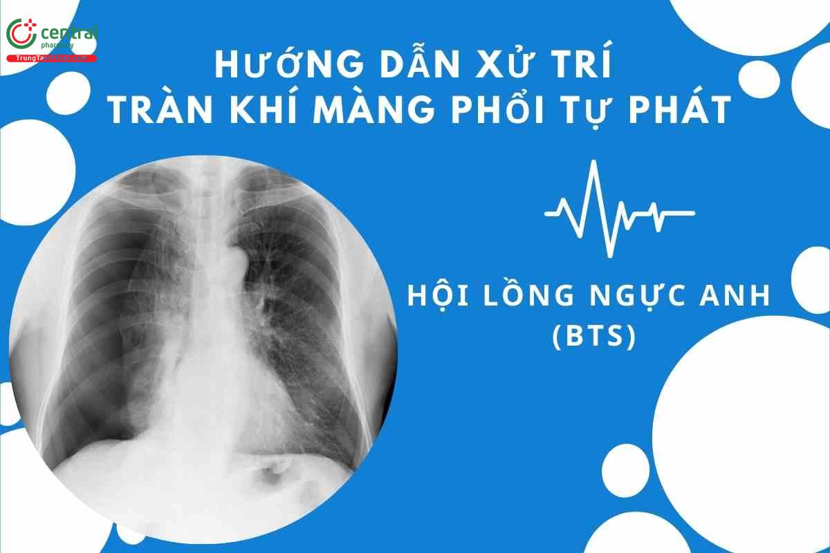 Hướng dẫn xử trí tràn khí màng phổi tự phát của hội lồng ngực Anh  