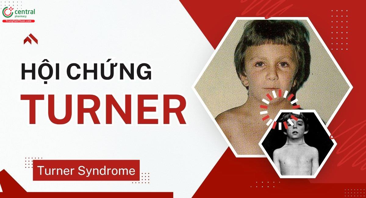 Hội chứng Turner có chữa được không? Nguyên nhân, triệu chứng thường gặp