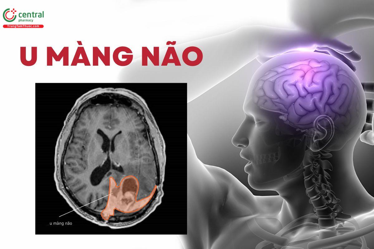 U màng não có nên mổ không? Triệu chứng và phương pháp chẩn đoán bệnh