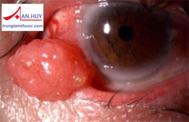Bệnh u mi, u kết mạc: nguyên nhân và điều trị bệnh