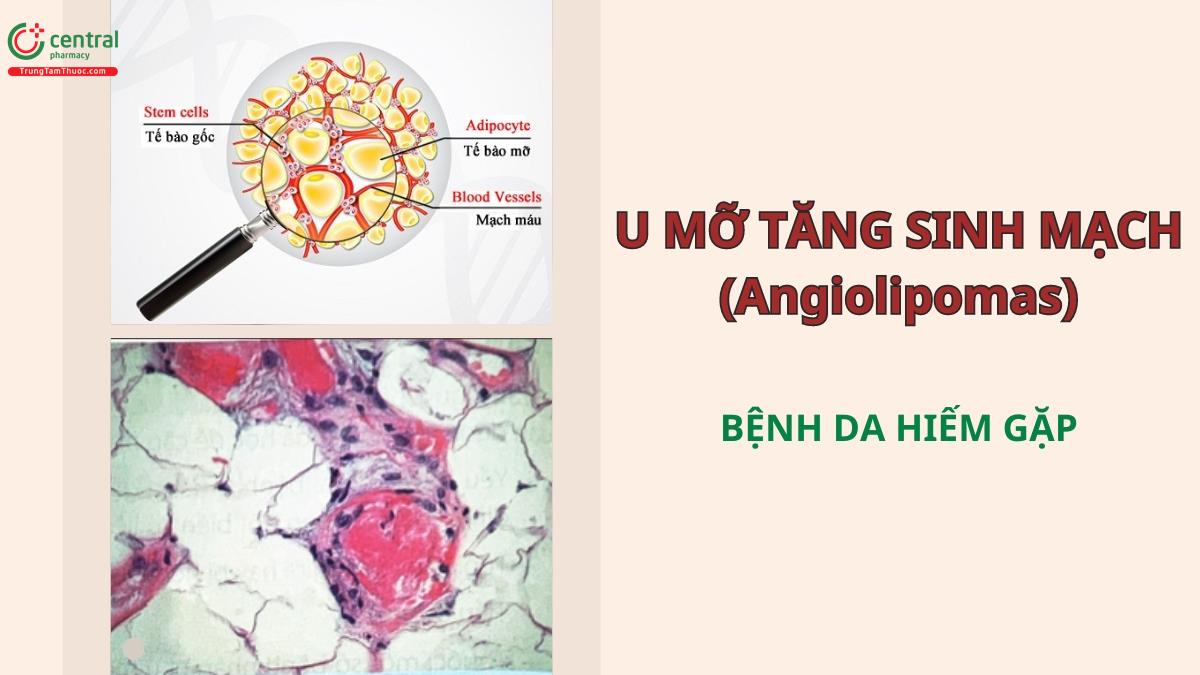 U mỡ tăng sinh mạch (Angiolipomas): Biểu hiện, cách chẩn đoán và điều trị