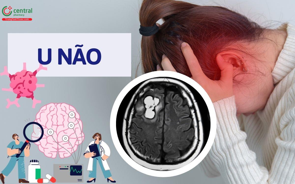 Bệnh u não có chữa được không? 7 dấu hiệu nhận biết u não giai đoạn đầu